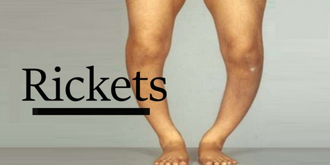 كساح الأطفال (Rickets)